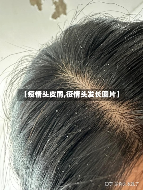 【疫情头皮屑,疫情头发长图片】-第1张图片